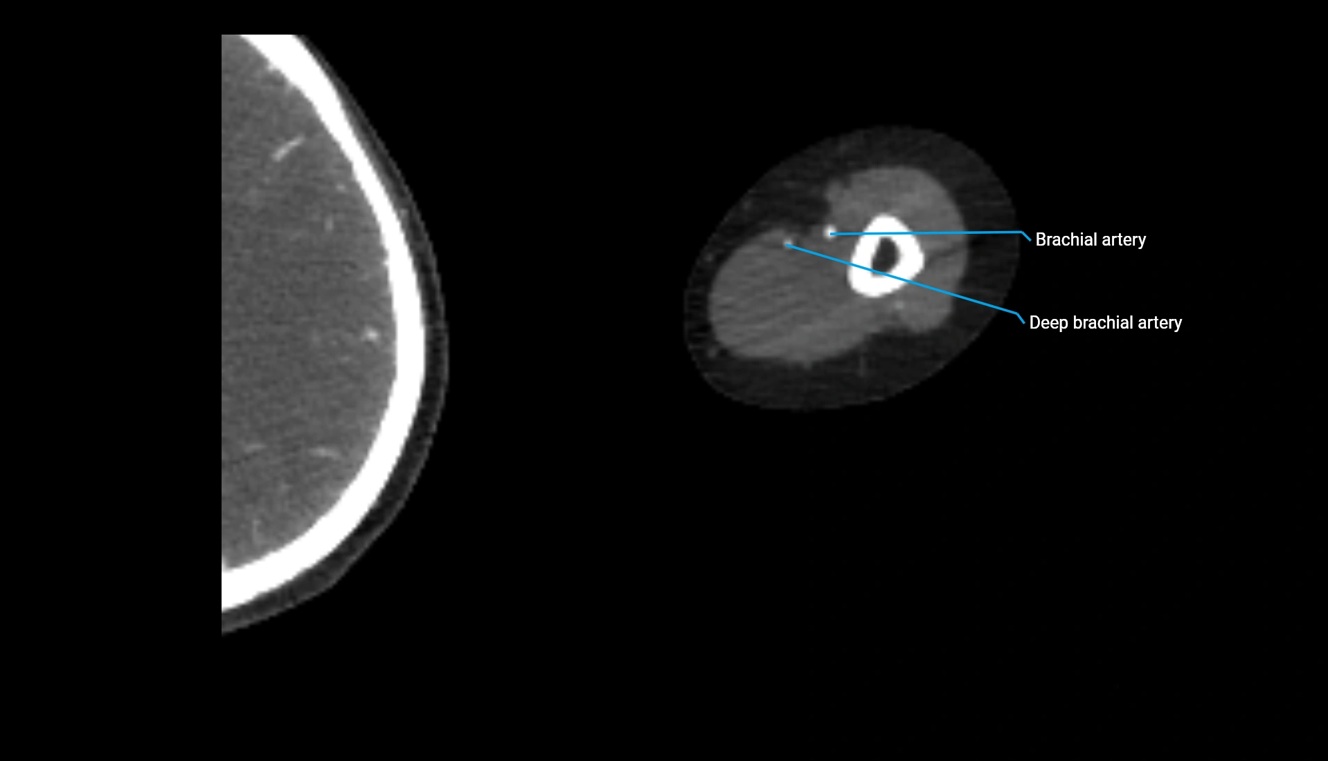 CTA upper limb axial cross sectional anatomy labelled image 232 (2).webp